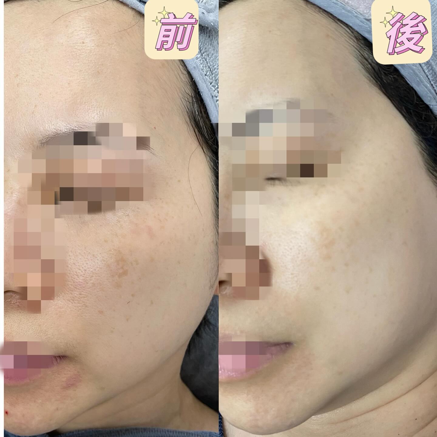 臉部護理前後對比照片