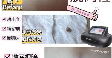 痘痘治療前後對比展示